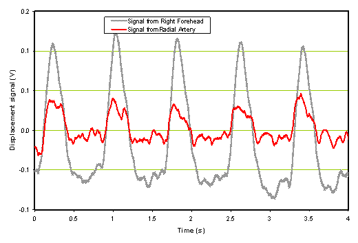 Time domain of hemorrhagic stroke patient